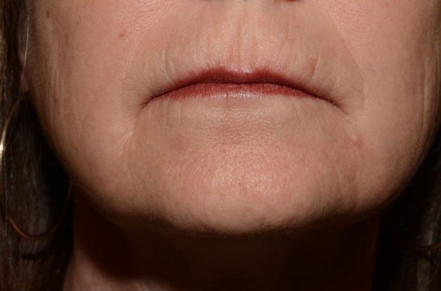 Facial Fat Grafting Case 1 - Indianapolis - After