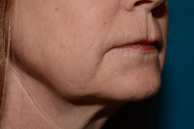 Facial Fat Grafting: Case 1 - Indianapolis - After