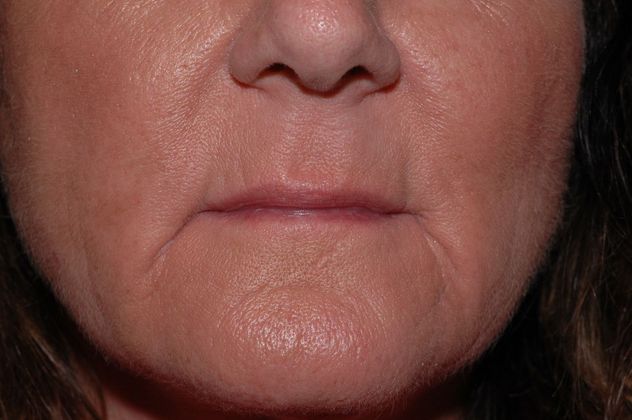 Facial Fat Grafting Case 2 - Zionsville - Before