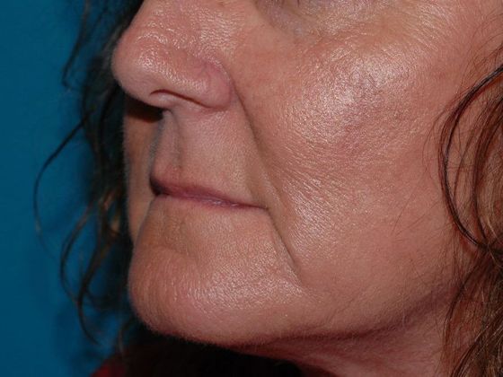 Facial Fat Grafting: Case 2 - Zionsville - Before