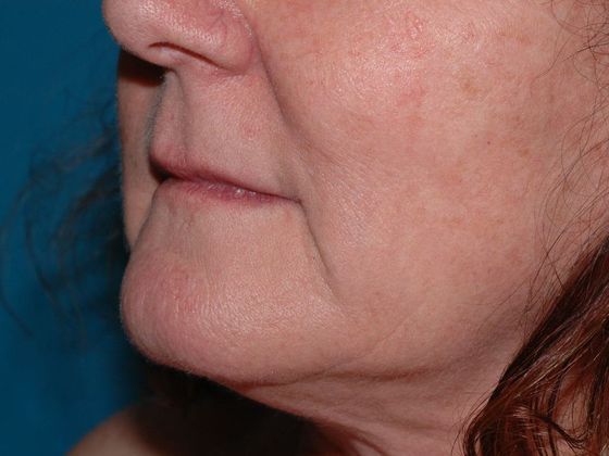 Facial Fat Grafting: Case 2 - Zionsville - After