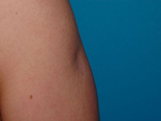 Fat Grafting Case 1 - Indianapolis - Before