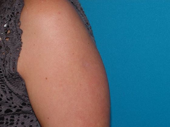 Fat Grafting Case 1 - Indianapolis - After