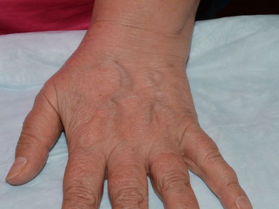 Fat Grafting Case 1 - Bloomington - Before