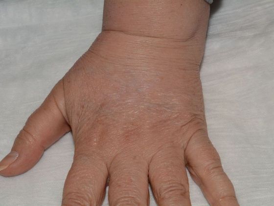 Fat Grafting Case 1 - Bloomington - After