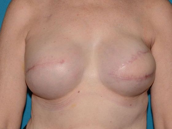Fat Grafting Case 3 - Avon - Before