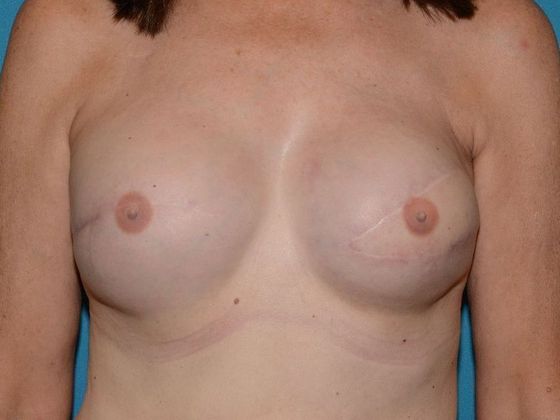 Fat Grafting Case 3 - Avon - After