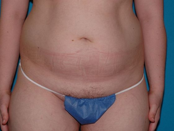 Liposuction: Case 3 - Fort Wayne - Before