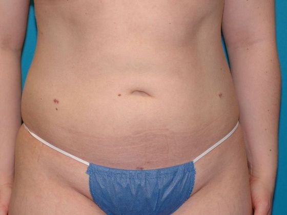 Liposuction: Case 3 - Fort Wayne - After