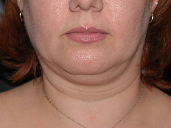 Liposuction: Case 6 - Muncie - Before