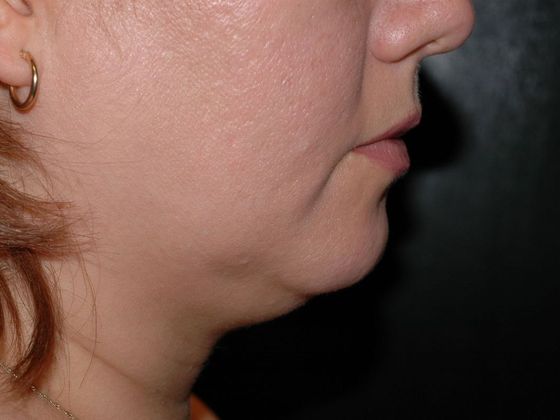 Liposuction: Case 6 - Muncie - Before