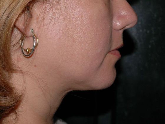 Liposuction: Case 6 - Muncie - After