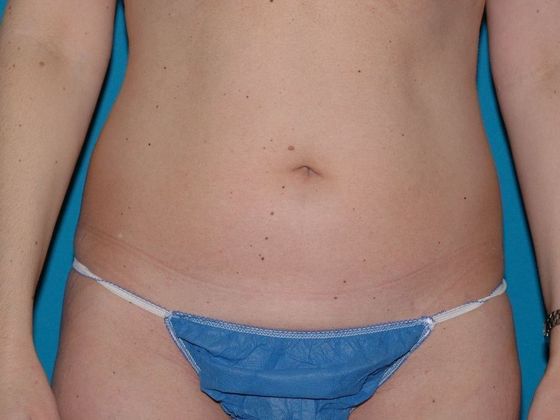 Liposuction: Case 7 - Carmel - Before