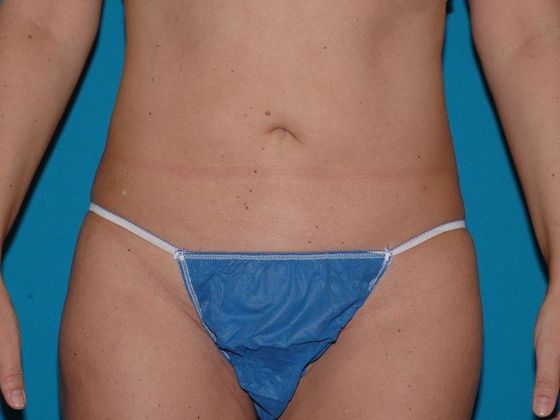 Liposuction: Case 7 - Carmel - After