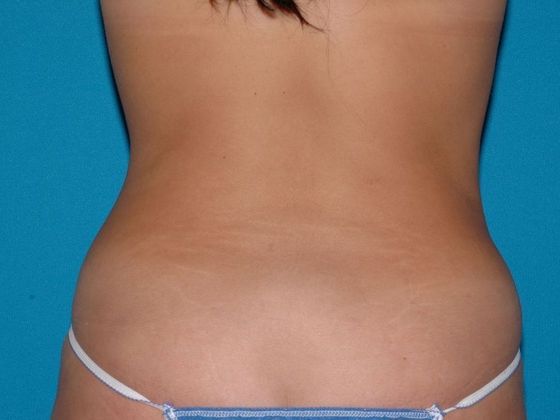 Liposuction: Case 8 - Fishers - Before