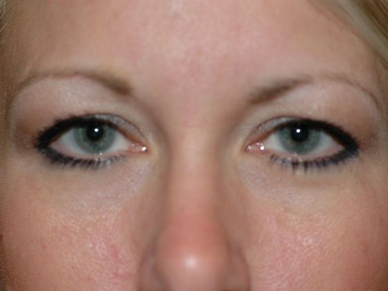 Eyelid Surgery: Case 4 - Zionsville - Before