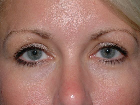 Eyelid Surgery: Case 4 - Zionsville - After