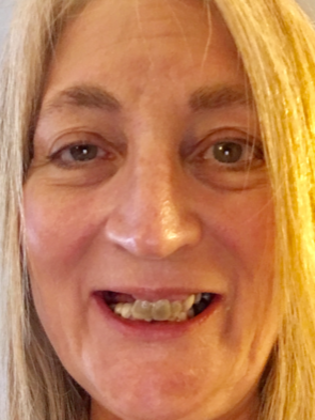 Dental Implants Case 4 - Before