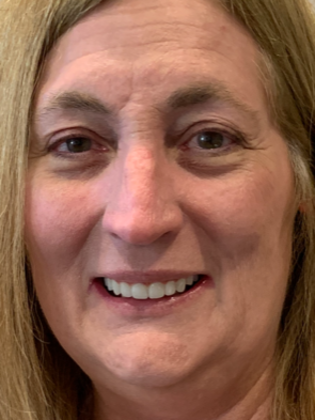 Dental Implants Case 4 - After