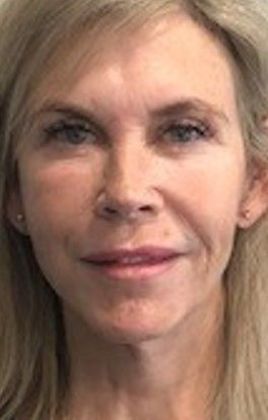 Facelift: Case 23 Facelift, Necklift, Mini Browlift, Upper Eyelid Lift, Norwalk - After