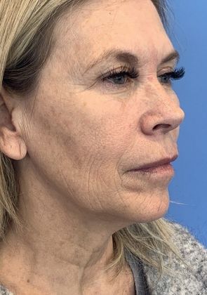 Facelift: Case 23 Facelift, Necklift, Mini Browlift, Upper Eyelid Lift, Norwalk - Before