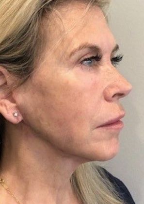 Facelift: Case 23 Facelift, Necklift, Mini Browlift, Upper Eyelid Lift, Norwalk - After
