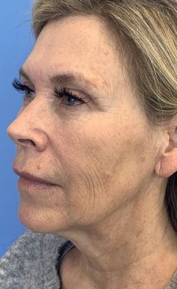 Facelift: Case 23 Facelift, Necklift, Mini Browlift, Upper Eyelid Lift, Norwalk - Before