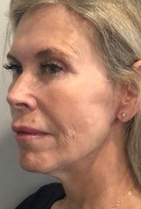 Facelift: Case 23 Facelift, Necklift, Mini Browlift, Upper Eyelid Lift, Norwalk - After