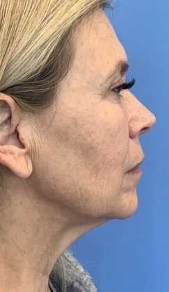 Facelift: Case 23 Facelift, Necklift, Mini Browlift, Upper Eyelid Lift, Norwalk - Before