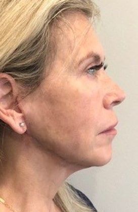 Facelift: Case 23 Facelift, Necklift, Mini Browlift, Upper Eyelid Lift, Norwalk - After