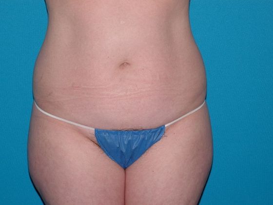 Liposuction: Case 9 - Fort Wayne - Before
