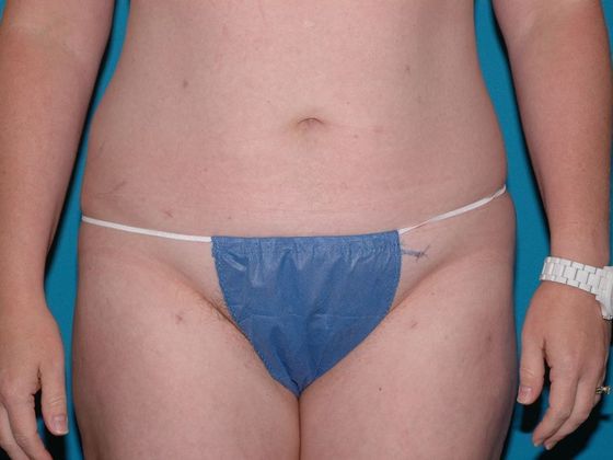 Liposuction: Case 9 - Fort Wayne - After
