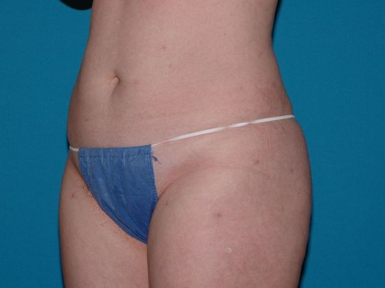 Liposuction: Case 9 - Fort Wayne - After