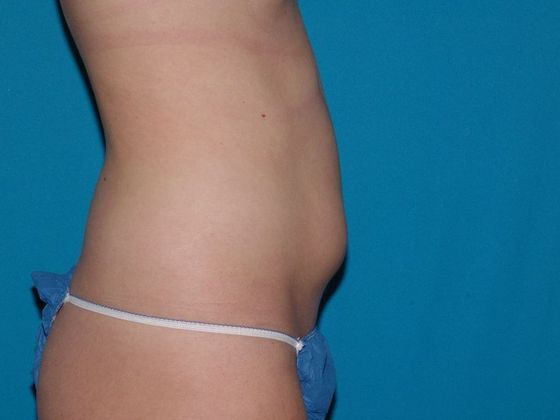 Liposuction: Case 10 - Terre Haute - Before