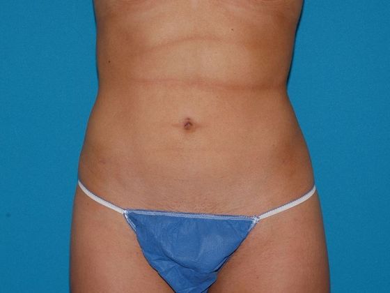 Liposuction: Case 10 - Terre Haute - After