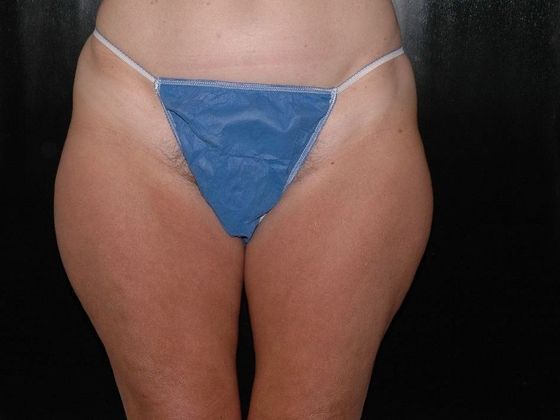 Liposuction: Case 11 - Kokomo - Before
