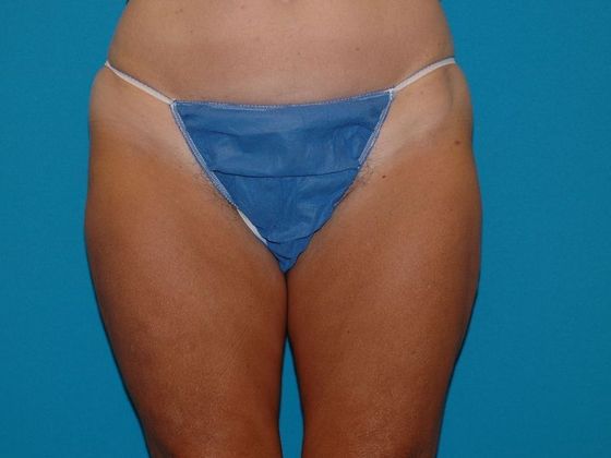 Liposuction: Case 11 - Kokomo - After