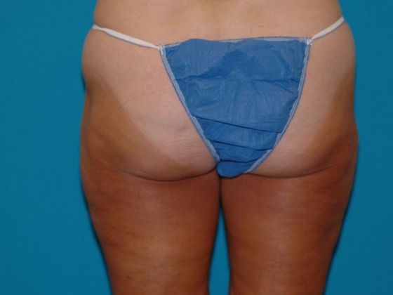 Liposuction: Case 11 - Kokomo - After