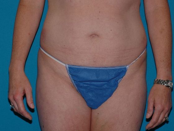 Liposuction: Case 12 - Zionsville - Before