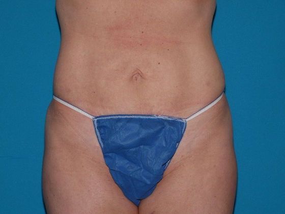Liposuction: Case 12 - Zionsville - After