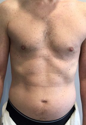 Liposuction Case 14 - Liposuction, Stamford - Before