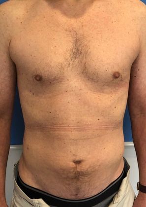 Liposuction Case 14 - Liposuction, Stamford - After