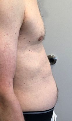 Liposuction: Case 14 - Liposuction, Stamford - Before