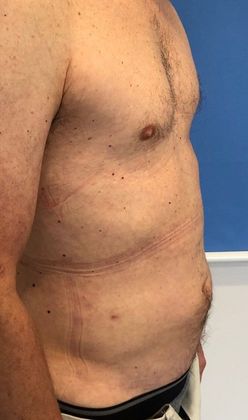Liposuction: Case 14 - Liposuction, Stamford - After