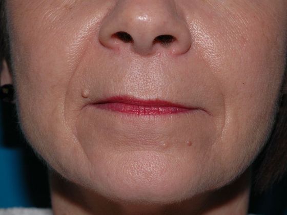 Facial Fat Grafting Case 3 - Muncie - Before