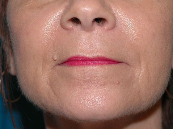 Facial Fat Grafting Case 3 - Muncie - After