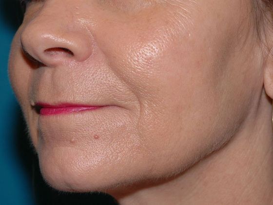 Facial Fat Grafting: Case 3 - Muncie - After