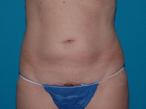 Liposuction: Case 13 - Indianapolis - Before