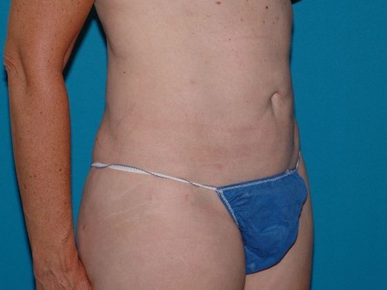 Liposuction: Case 13 - Indianapolis - After