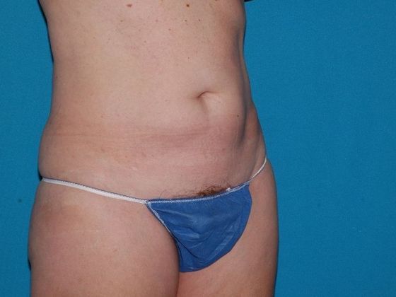 Liposuction: Case 13 - Indianapolis - Before